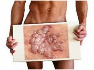 Папилломы на половом члене