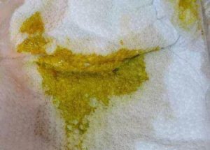 Жидкий стул со слизью у грудного ребенка