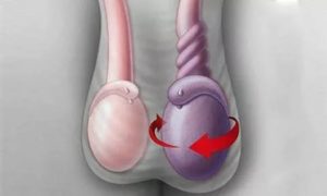 Левое яичко больше правого