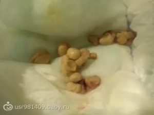 Ребенок какает шариками, как камyшки