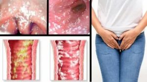 Жжение и гиперемия во влагалище