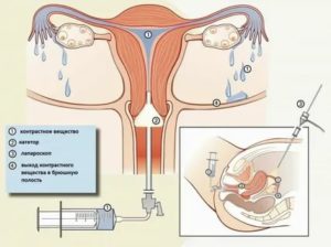 Проходимость маточных труб