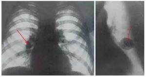 Правый корень расширен при Рентген обследование