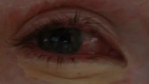 Кот поцарапал глазное яблоко