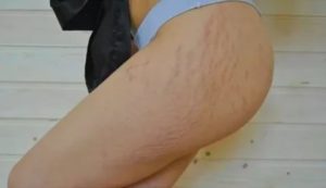 Сильное жжение кожи внизу живота и ляшках до колен