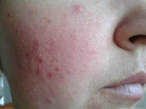 Зудящие высыпания на лице