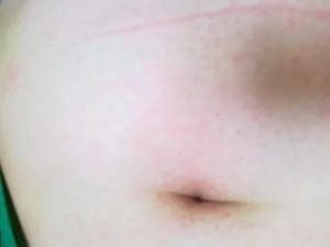 Сыпь над пупком