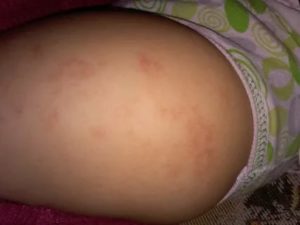 Сыпь на попе у подростка