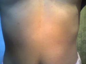 Сыпь на груди животе и спине