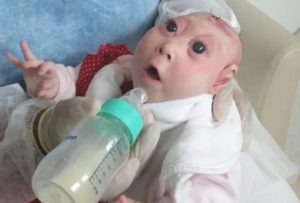 Акрания плода