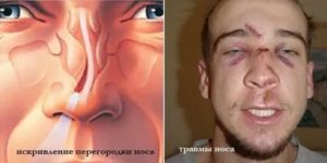 Течет жидкость из носа по утрам