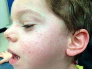 Температура и сыпь на лице