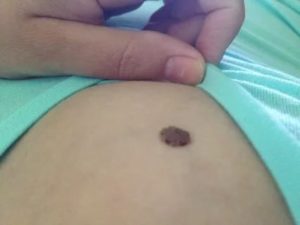 Родинка на груди у ореолы