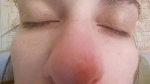 Пятно на носу шелушится